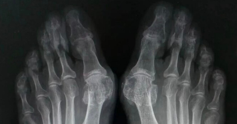 Рентгенография обеих стоп в двух проекциях с нагрузкой