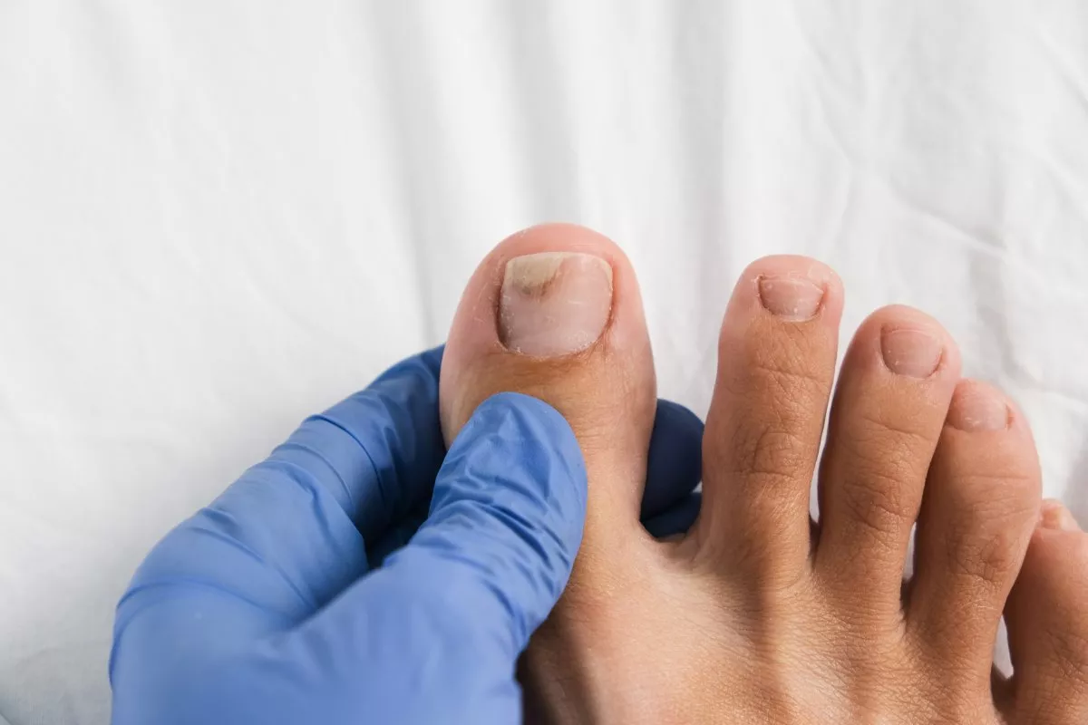Лечение отслоения ногтя на ногах