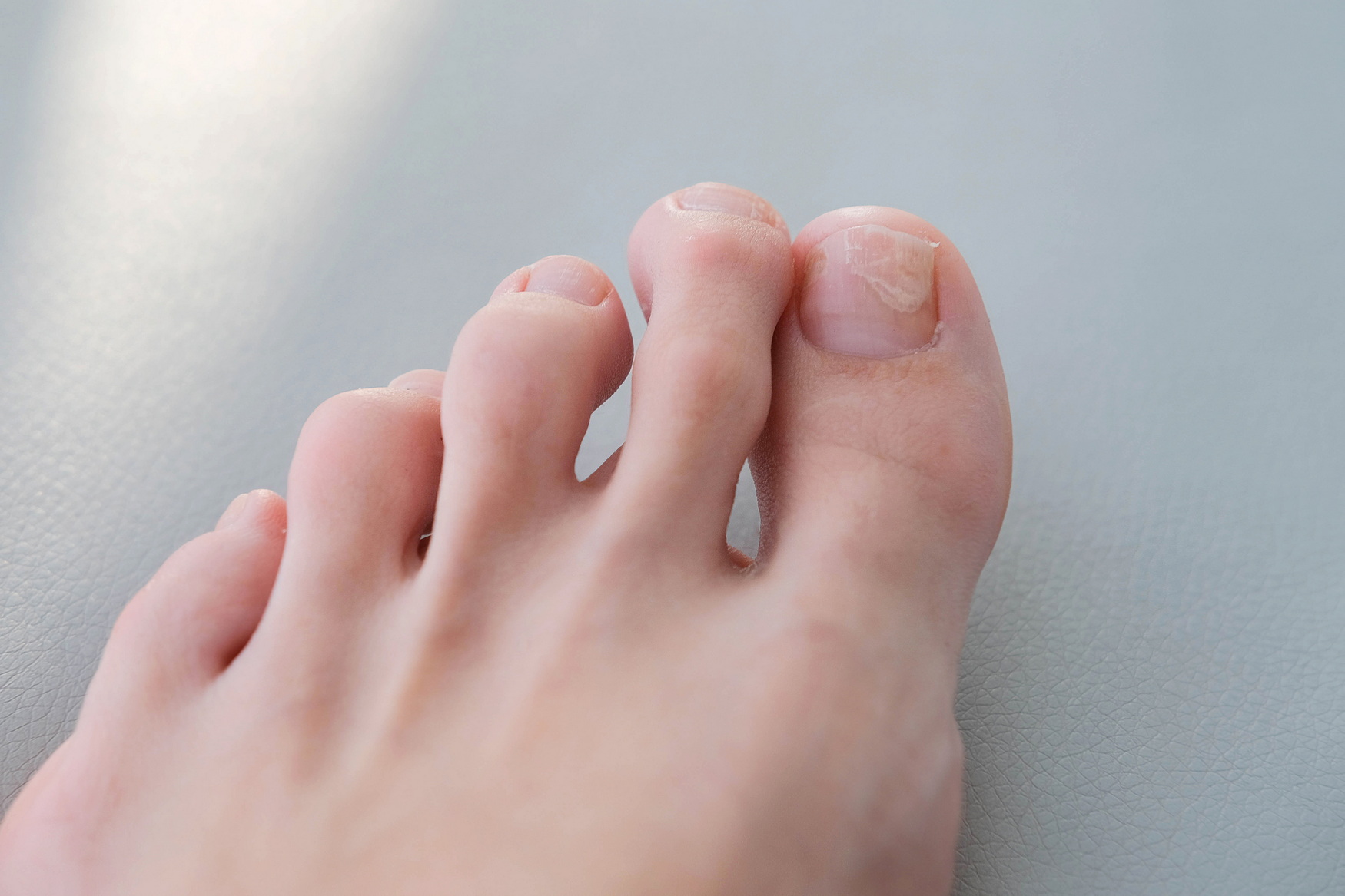 Гиперкератоз ногтей: причины и методы лечения патологии ногтевой пластины