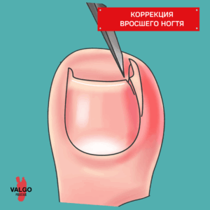 удаление вросшего ногтя
