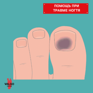 помощь при травме ногтя