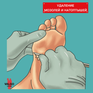 удаление мозоли