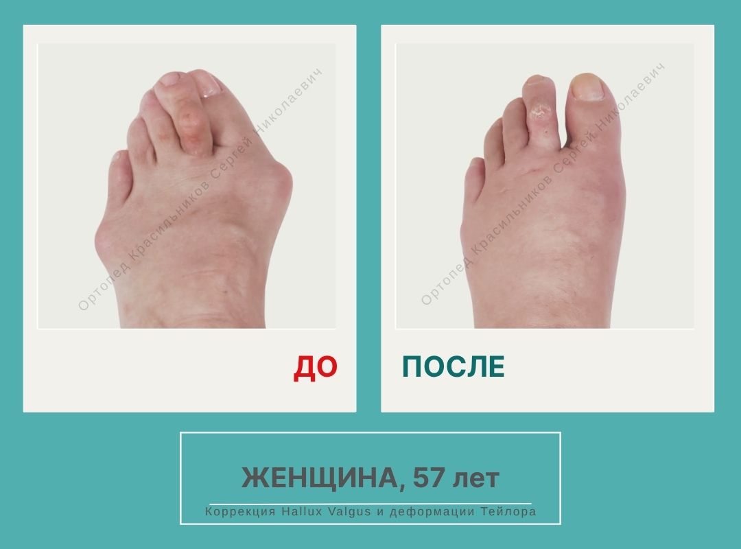 КСН ДО ПОСЛЕ НА САЙТ_Арданова