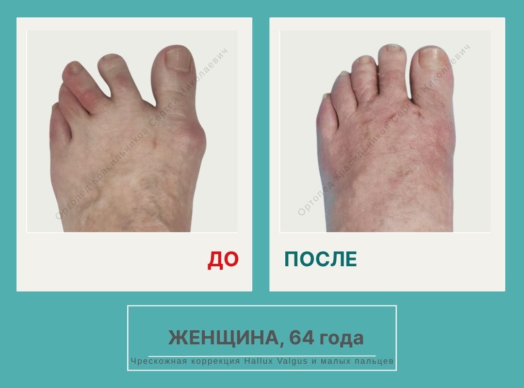 КСН ДО ПОСЛЕ НА САЙТ_Вальщикова L