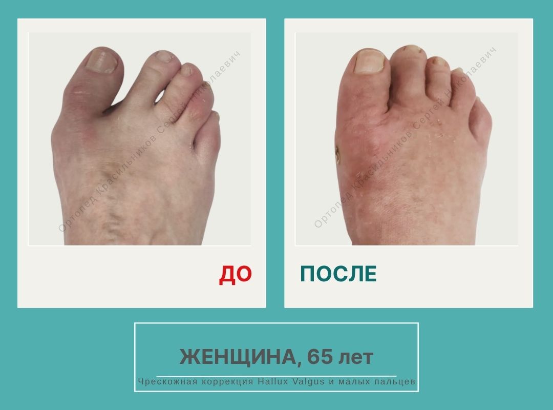 КСН ДО ПОСЛЕ НА САЙТ_Вальщикова R